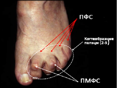 Расхождение пальцев на ногах: причины и возможные факторы
